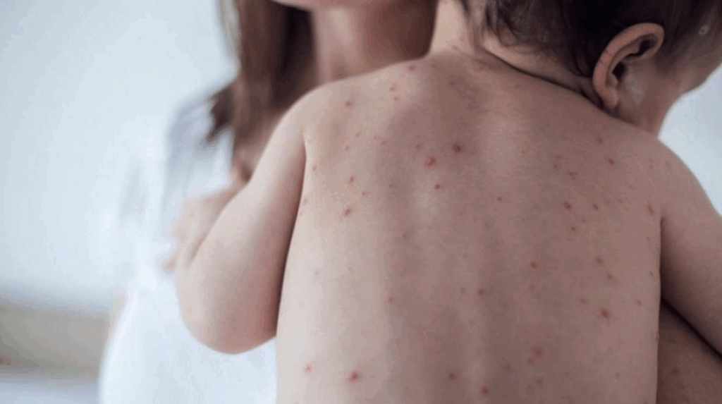 La Provincia vuelve a encender la alerta por sarampión y apunta contra el Gobierno nacional por la caída en la vacunación